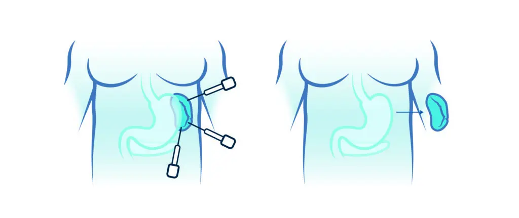 Esplenectomía: Qué es, por qué se realiza y qué esperar - Qué pasa si el bazo se extirpa esplenectomia - Qué pasa si el bazo se extirpa