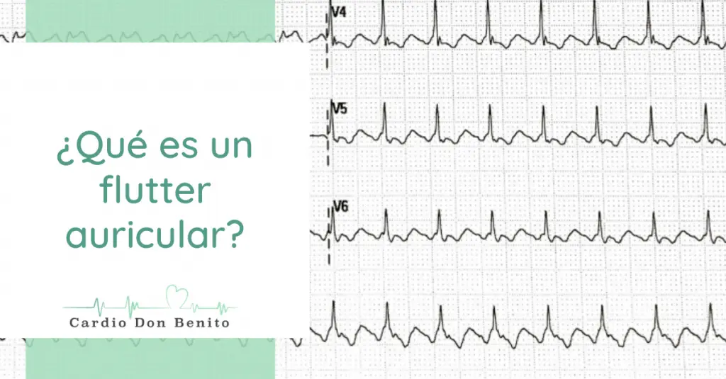 Aleteo Auricular: Causas, Síntomas, Diagnóstico y Tratamiento - Qué pasa si escucho un aleteo en el oído aleteo auricular - Qué pasa si escucho un aleteo en el oído