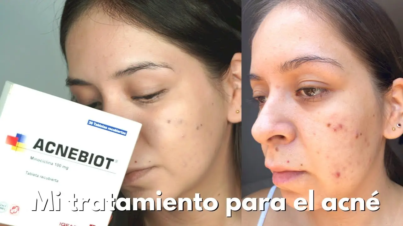 Minociclina: Efectos Secundarios Y Riesgos Potenciales | Doctor Online