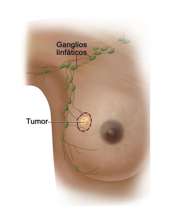 ganglio centinela negativo quimioterapia - Qué pasa si hay cáncer en el ganglio centinela