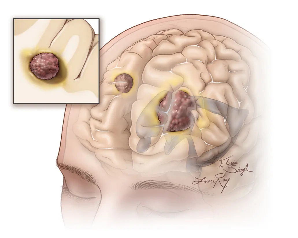 Metástasis Cerebral: Síntomas, Tratamiento y Todo Lo Que Necesitas Saber - Qué pasa si hay metástasis en el cerebro metastasis cerebral - Qué pasa si hay metástasis en el cerebro