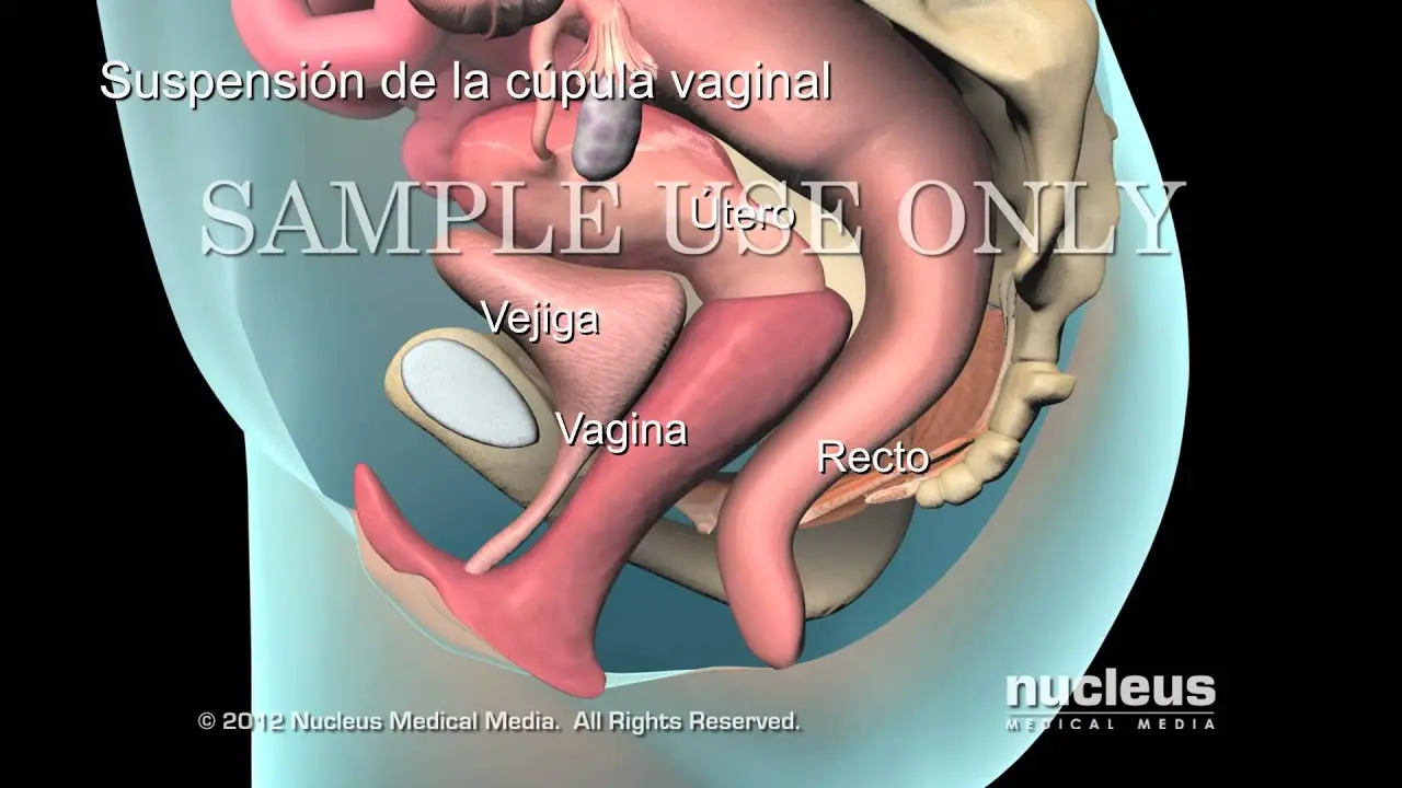 Prolapso Uterino: ¿Qué Pasa Si No Me Opero? - Qué pasa si no me opero el prolapso operacion de prolapso uterino - Qué pasa si no me opero el prolapso