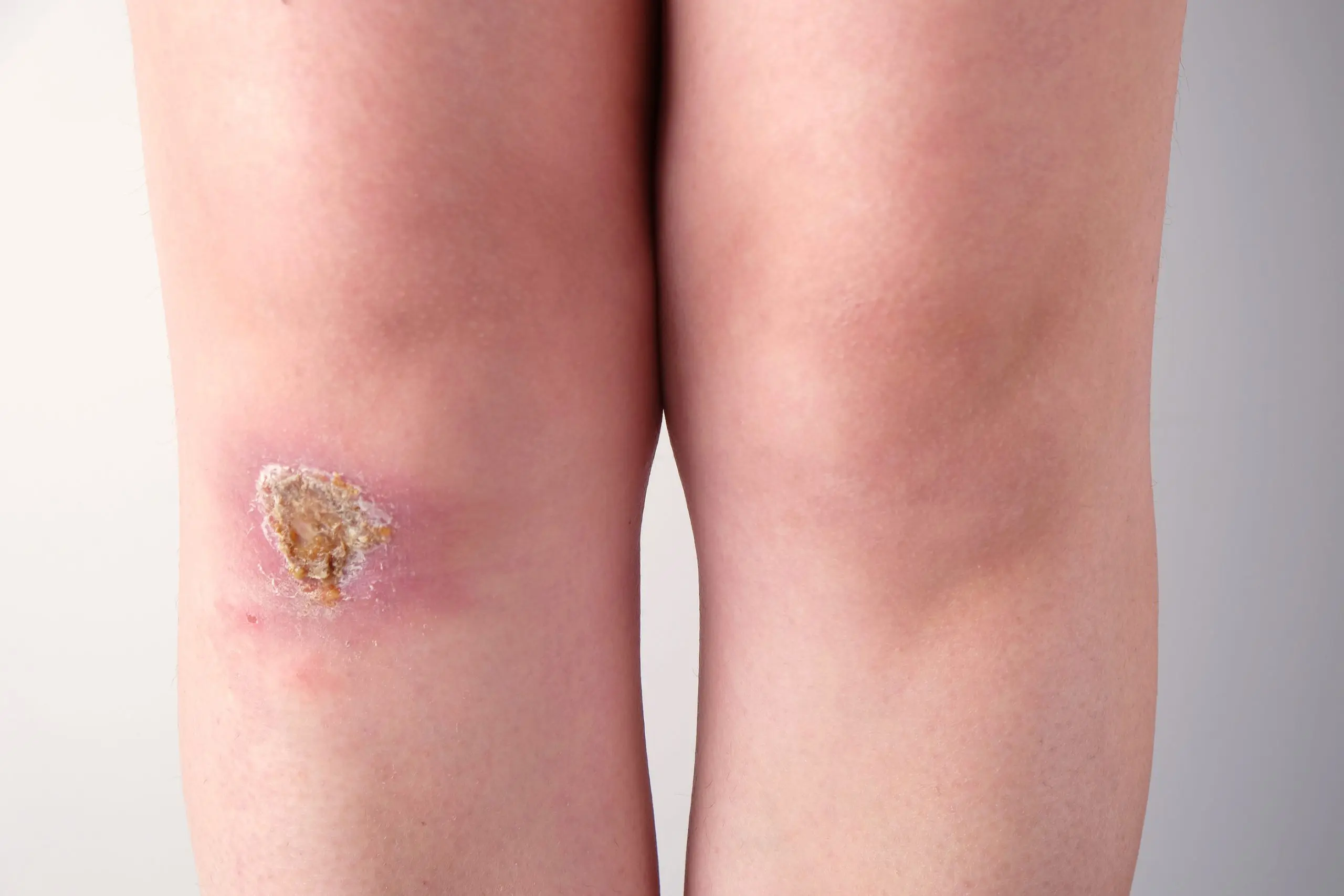 Cómo limpiar una herida infectada: Guía completa para una curación exitosa - Qué pasa si no se limpia una herida infectada como limpiar una herida infectada - Qué pasa si no se limpia una herida infectada