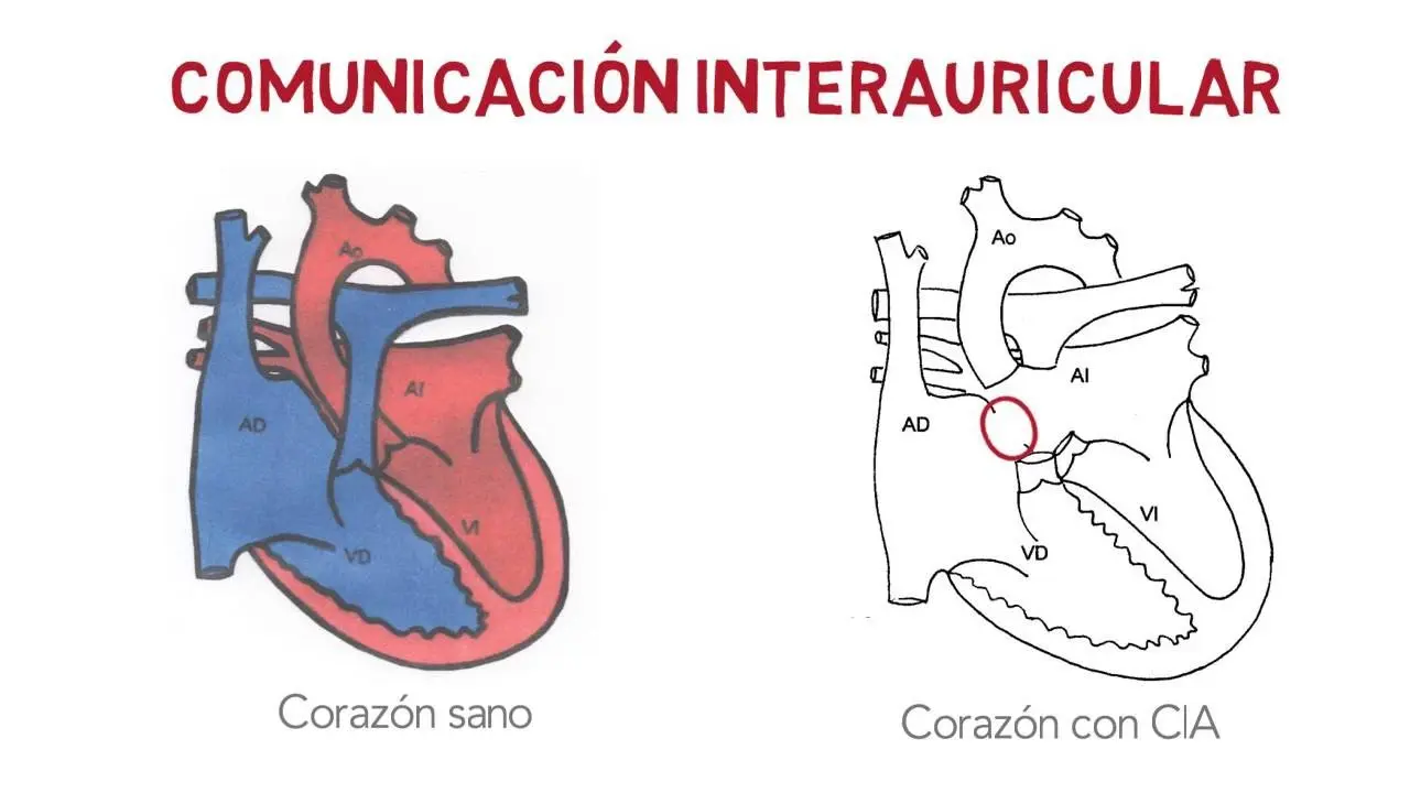 Comunicación Interauricular: Diagnóstico, Tratamiento y Consejos - Qué pasa si no se opera una CIA comunicacion interauricular - Qué pasa si no se opera una CIA