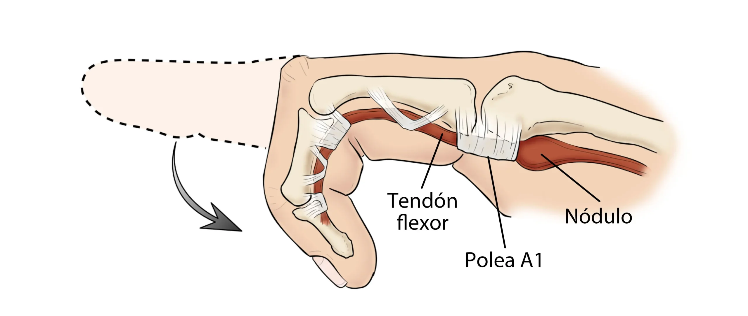 Dedo en Resorte: Causas, Síntomas y Tratamiento - Qué pasa si no se trata el dedo en gatillo dedo pulgar en resorte - Qué pasa si no se trata el dedo en gatillo