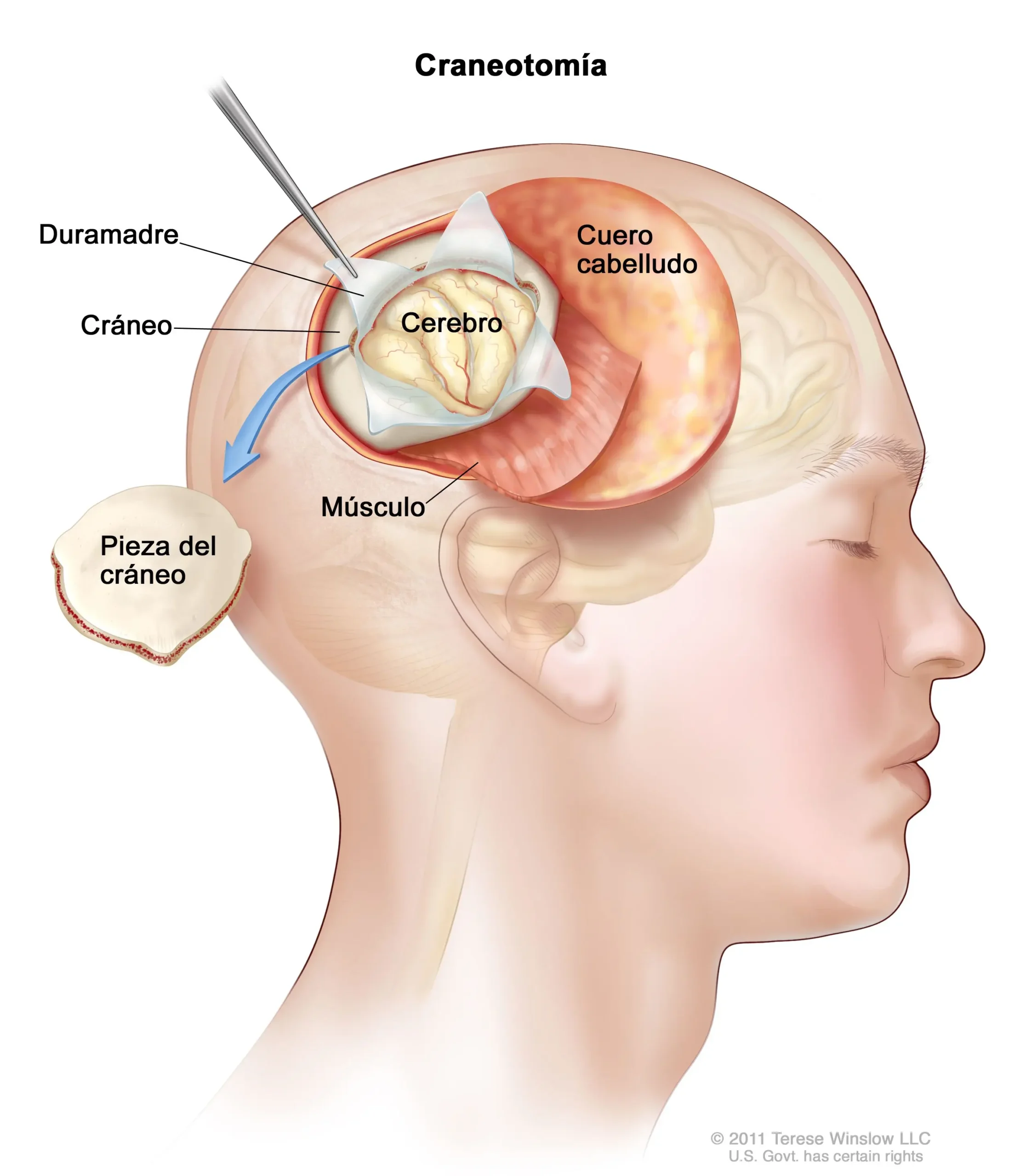 Extirpación de un tumor maligno: Riesgos, efectos secundarios y recuperación - Qué pasa si se extirpa un tumor maligno tumor maligno en la cabeza - Qué pasa si se extirpa un tumor maligno