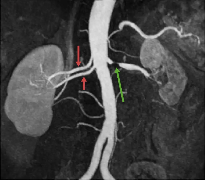 Estenosis de la Arteria Renal: Causas, Síntomas, Diagnóstico y Tratamiento - Qué pasa si se obstruye una arteria renal estenosis renal - Qué pasa si se obstruye una arteria renal