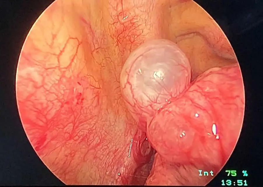 Bulla Pulmonar: ¿Tiene Cura? Entendiendo Esta Condición Respiratoria - Qué pasa si se rompe una bulla pulmonar la bulla pulmonar tiene cura - Qué pasa si se rompe una bulla pulmonar