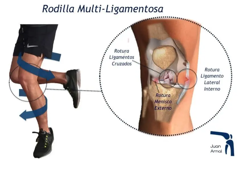 Rotura del Ligamento Cruzado Anterior: Síntomas, Causas, Diagnóstico y Tratamiento - Qué pasa si se te rompe el ligamento de la rodilla rotura de ligamentos rodilla - Qué pasa si se te rompe el ligamento de la rodilla