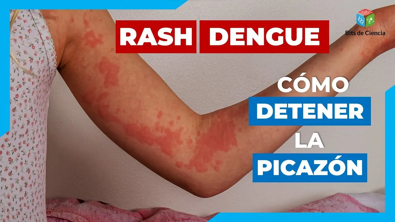 Sarpullido y Dengue: Entendiendo los Síntomas - Qué pasa si tengo dengue y se me pone la piel roja sarpullido dengue sintomas - Qué pasa si tengo dengue y se me pone la piel roja