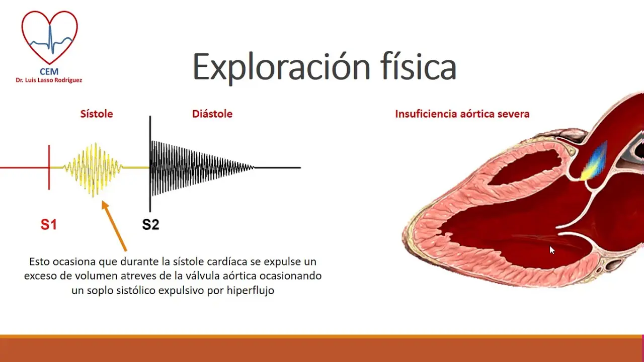 Insuficiencia Aórtica Leve: ¿Cuándo Operar y Cómo Mejorarla? - Qué pasa si tengo insuficiencia aórtica leve insuficiencia aortica leve - Qué pasa si tengo insuficiencia aórtica leve