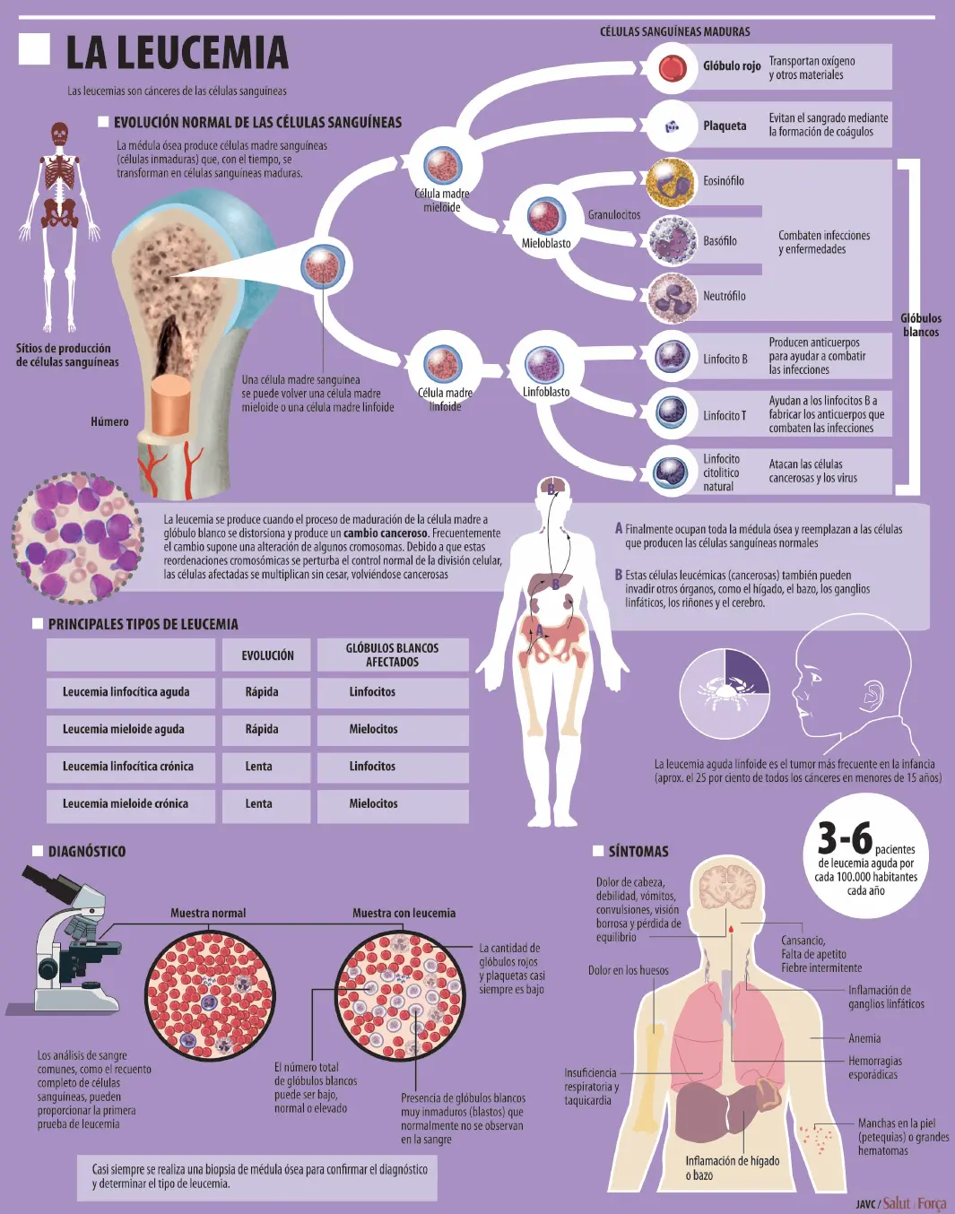 Leucemia: ¿Es contagiosa? Todo lo que necesitas saber - Qué pasa si tengo relaciones con alguien que tiene leucemia la leucemia es contagiosa - Qué pasa si tengo relaciones con alguien que tiene leucemia
