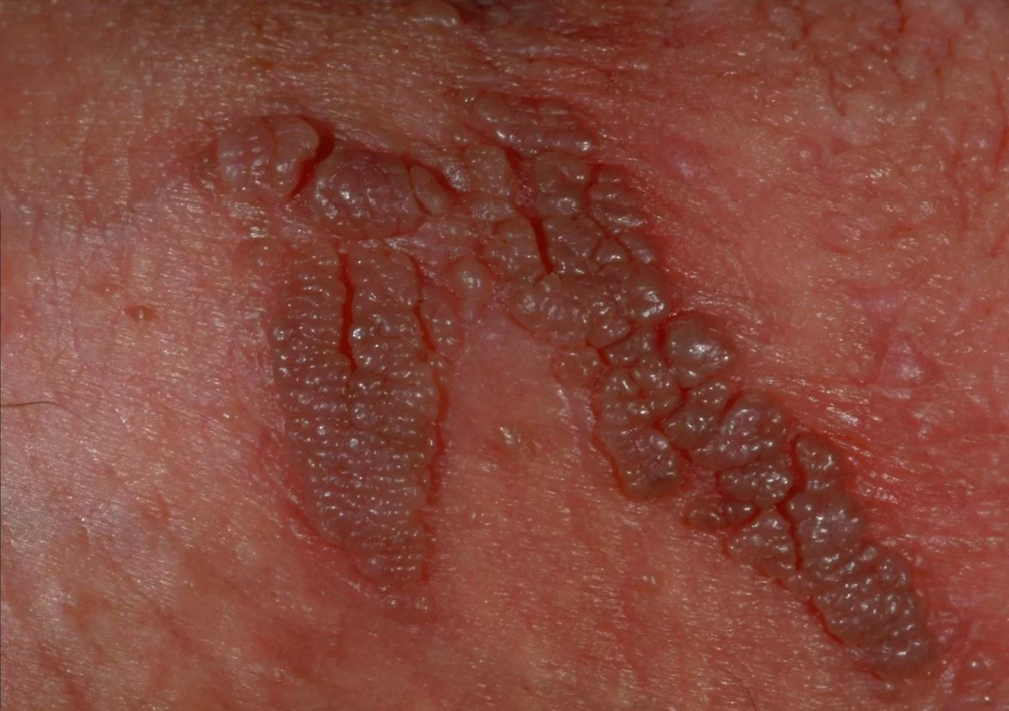Verrugas en la Vulva: Qué son, Causas, Síntomas y Tratamiento - Qué pasa si tengo verrugas y no es VPH verrugas en la vulva - Qué pasa si tengo verrugas y no es VPH