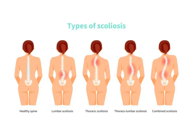 escoliosis toracica - Qué pasa si tienes escoliosis