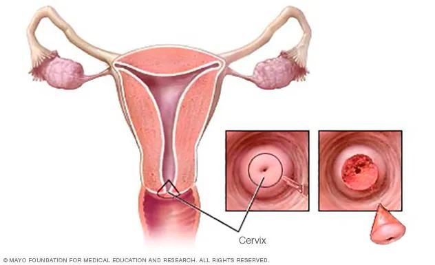 Biopsia de Cuello Uterino: Qué Esperar, Riesgos y Resultados - Qué pasa si una biopsia de cuello uterino sale negativa biopsia de cuello uterino - Qué pasa si una biopsia de cuello uterino sale negativa