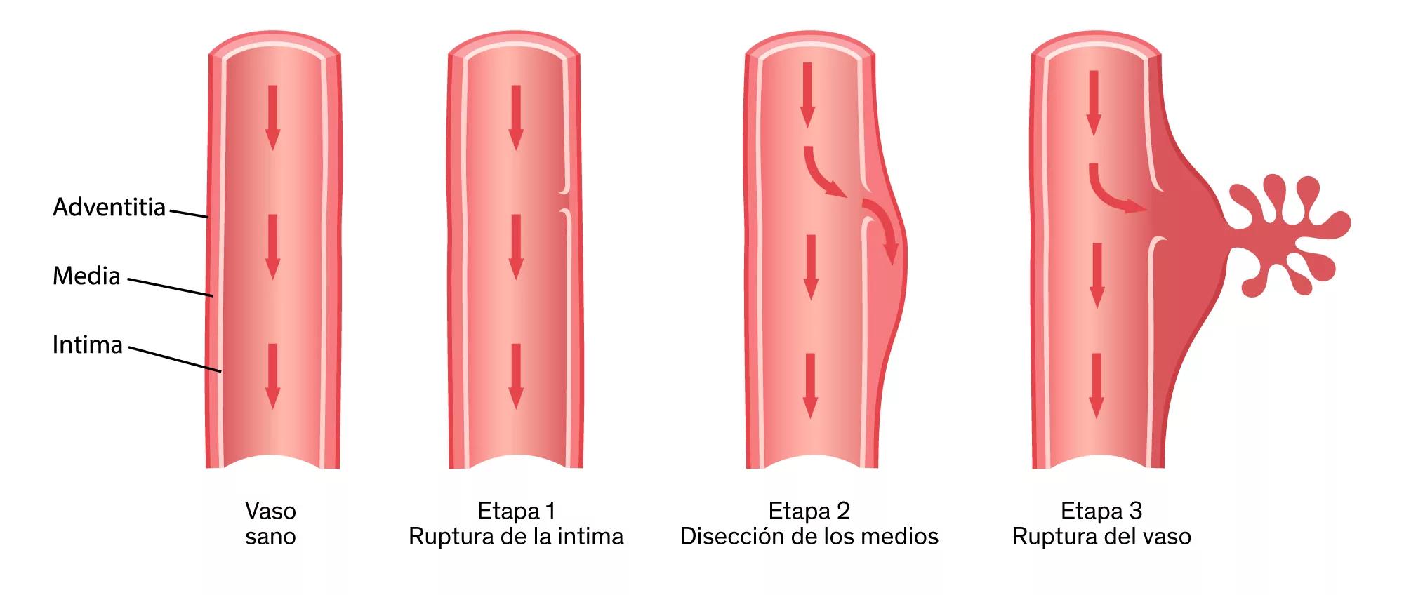 Disección Aórtica: Estado del Arte - Qué porcentaje de pacientes con disección aórtica muere si no reciben tratamiento en las dos primeras semanas diseccion aortica - Qué porcentaje de pacientes con disección aórtica muere si no reciben tratamiento en las dos primeras semanas