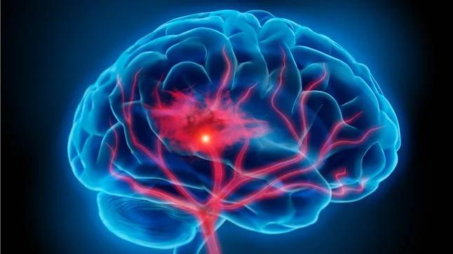 Hemorragia Cerebral: Causas, Síntomas, Tratamiento y Recuperación - Qué probabilidades hay de sobrevivir a una hemorragia cerebral hemorragia cerebral - Qué probabilidades hay de sobrevivir a una hemorragia cerebral