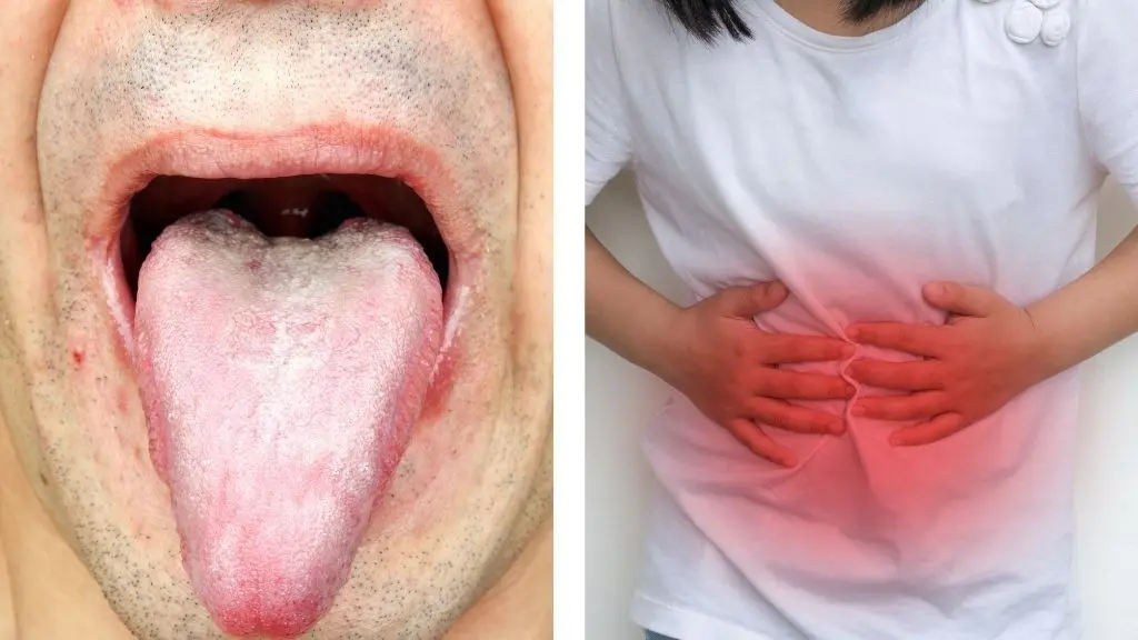 Lengua Blanca: Causas, Síntomas y Soluciones - Qué problema intestinal pone la lengua blanca lengua blanca y dolor de garganta - Qué problema intestinal pone la lengua blanca