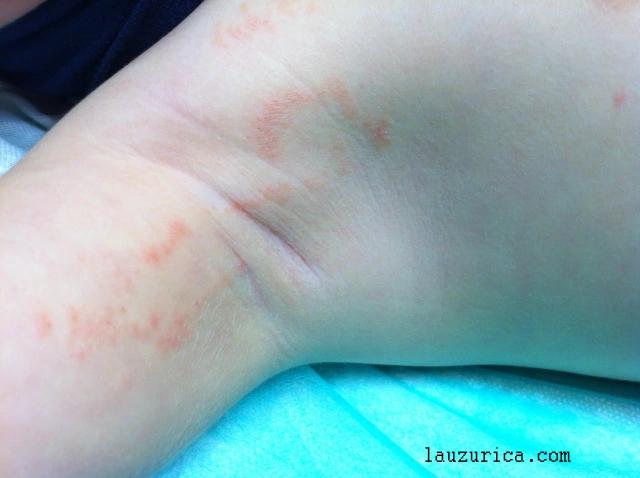 Liquen Estriado: Una Dermatosis Autolimitada - Qué produce el liquen estriado liquen estriado - Qué produce el liquen estriado