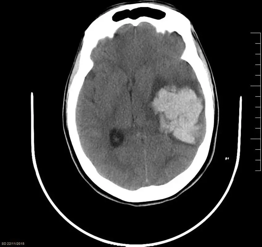 Hematoma Intraparenquimatoso: Causas, Síntomas y Tratamiento - Qué produce la hemorragia intraparenquimatosa hematoma intraparenquimatoso - Qué produce la hemorragia intraparenquimatosa
