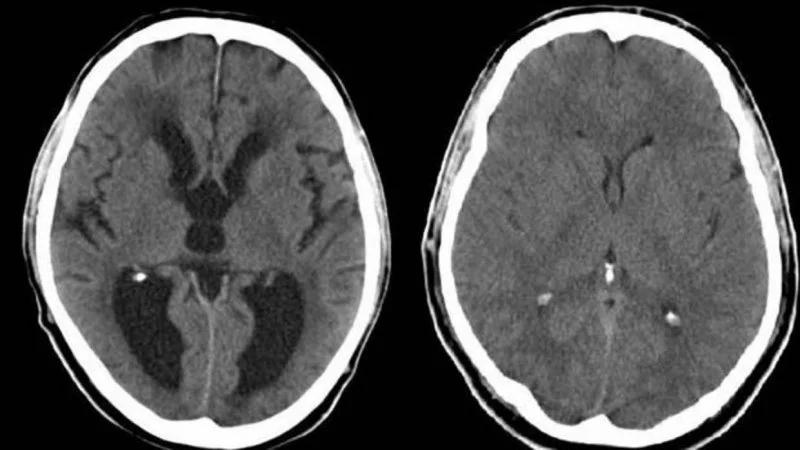 Hidrocefalia: ¿Qué pasa si hay líquido en el cerebro? - Qué produce la hidrocefalia en adultos liquido en el cerebro - Qué produce la hidrocefalia en adultos