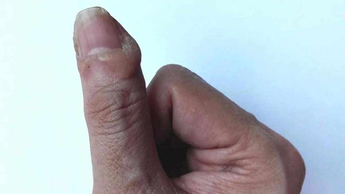 Síndrome de CREST: Causas, Síntomas y Evolución - Qué provoca el síndrome de CREST sindrome de crest - Qué provoca el síndrome de CREST
