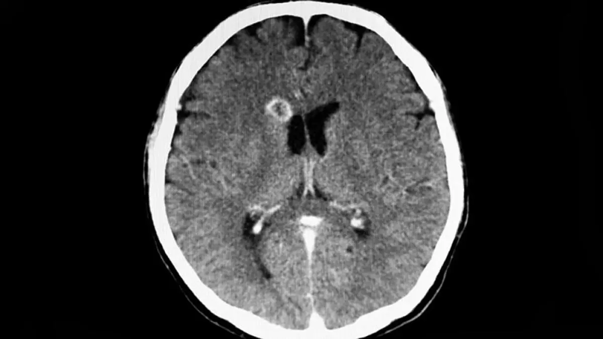 Cisticercosis Cerebral: Una Enfermedad Grave y Prevenible - Qué provoca la cisticercosis cisticercosis cerebral - Qué provoca la cisticercosis