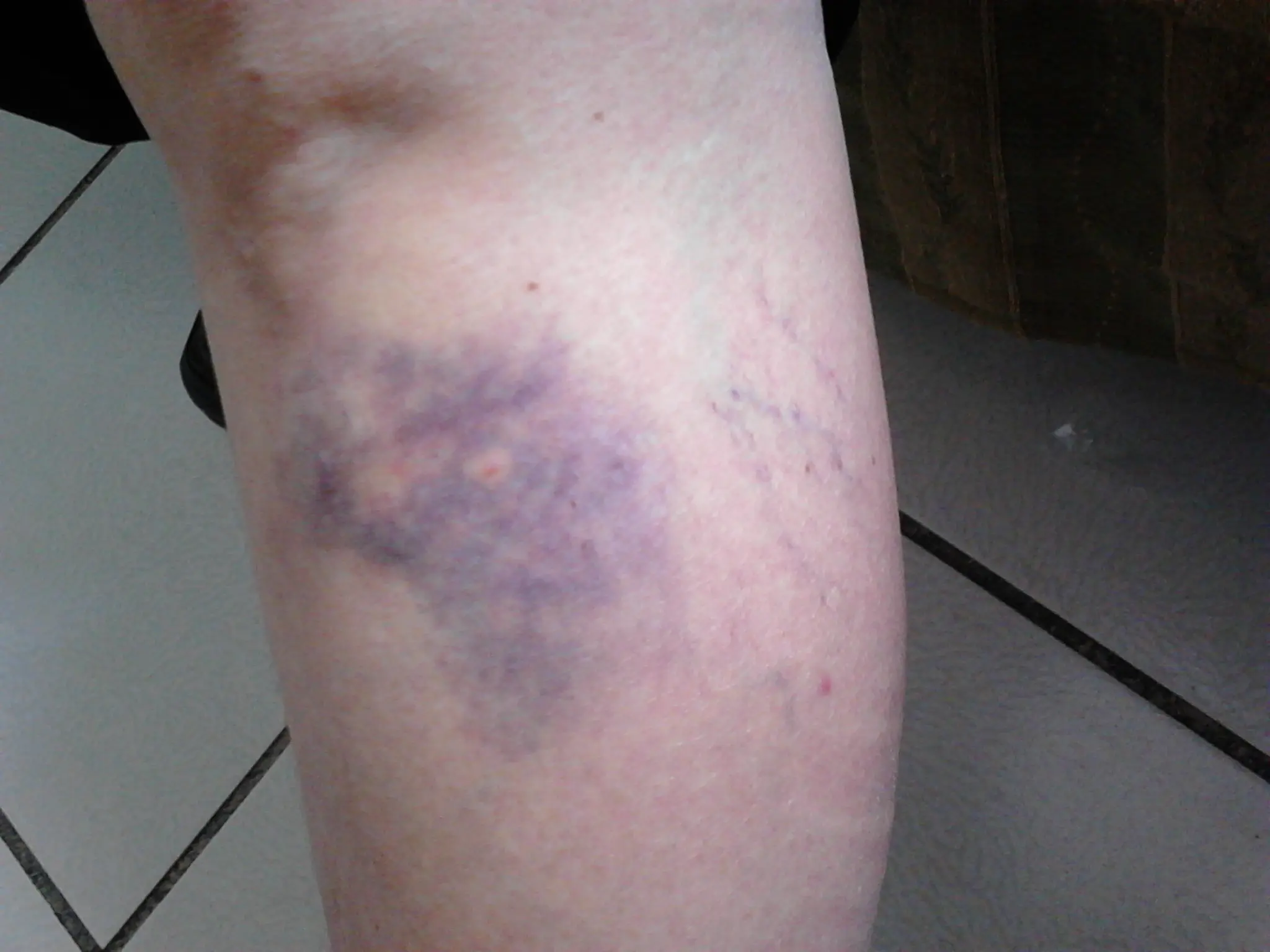 que es la dermatomiositis - Qué provoca la dermatomiositis