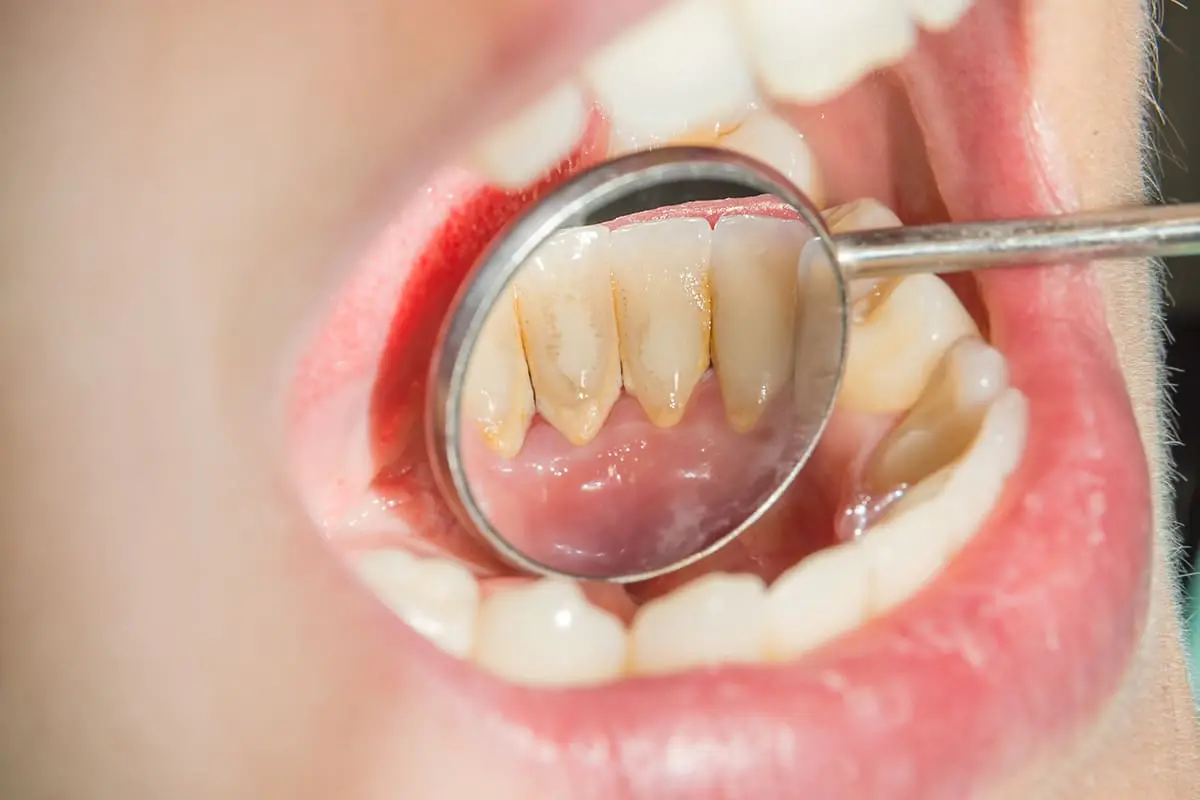 Placa Bacteriana: Causas, Efectos y Cómo Prevenirla - Qué provoca la placa bacteriana dientes con placa bacteriana - Qué provoca la placa bacteriana