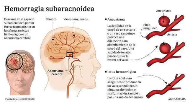 Hemorragia Cerebral: Causas, Síntomas, Tratamiento y Recuperación - Qué provoca un derrame cerebral hemorragia cerebral - Qué provoca un derrame cerebral