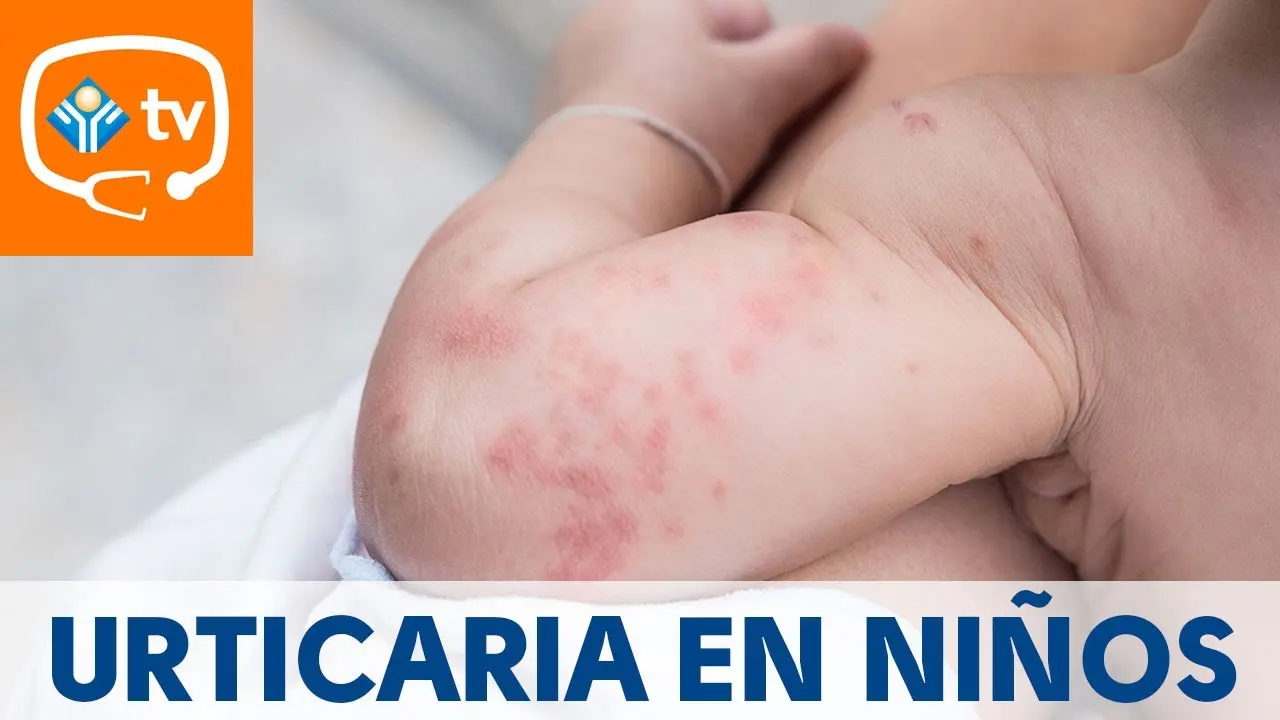 Urticaria en Bebés: Causas, Síntomas y Tratamiento - Qué provoca urticaria en niños urticaria en bebes - Qué provoca urticaria en niños