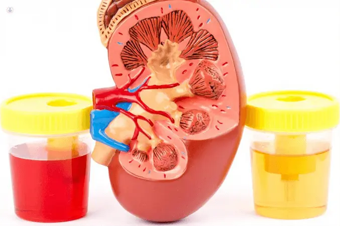 hematuria en orina - Qué puede causar hematuria microscópica