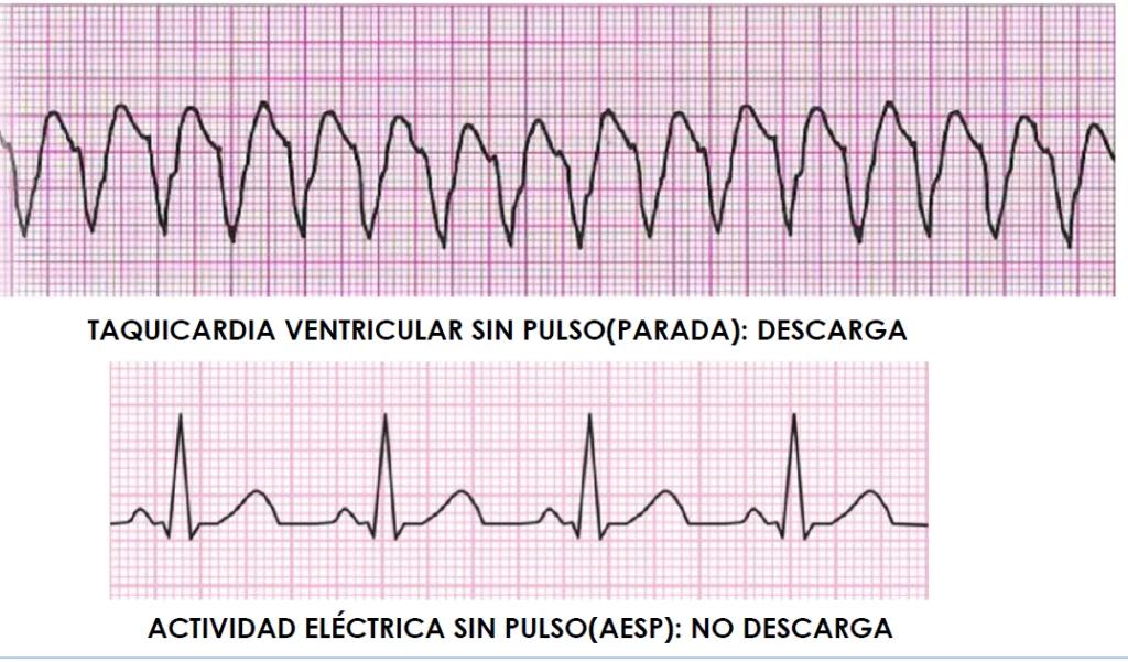 Taquicardia Ventricular: Causas, Diagnóstico y Tratamiento - Qué puede causar una taquicardia ventricular taquicardia ventricular - Qué puede causar una taquicardia ventricular