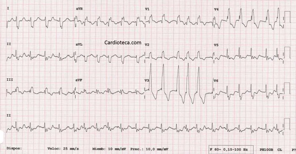 Diagnóstico de la Fibrilación Auricular: Una Guía Completa - Qué puede desencadenar una fibrilación auricular faarv diagnostico - Qué puede desencadenar una fibrilación auricular