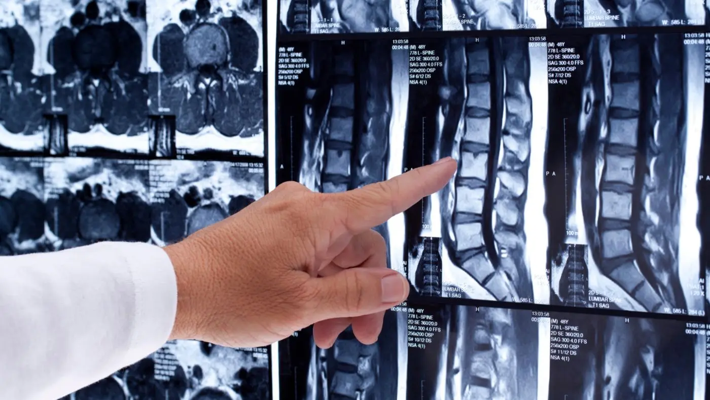 Resonancia Magnética de la Columna Lumbar: Explorando la Salud de tu Espalda Baja - Qué puede mostrar la resonancia magnética de la columna lumbar resonancia columna lumbar - Qué puede mostrar la resonancia magnética de la columna lumbar