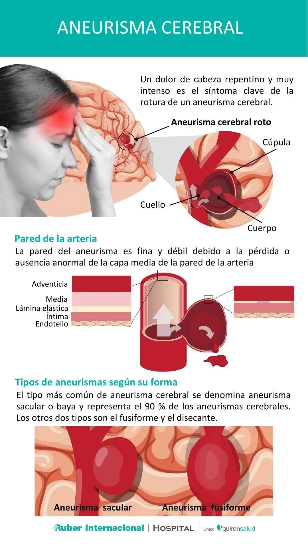 Embolización de Aneurisma Cerebral: Un Procedimiento para Tratar Aneurismas - Qué puede pasar después de una embolización embolizacion aneurisma cerebral - Qué puede pasar después de una embolización