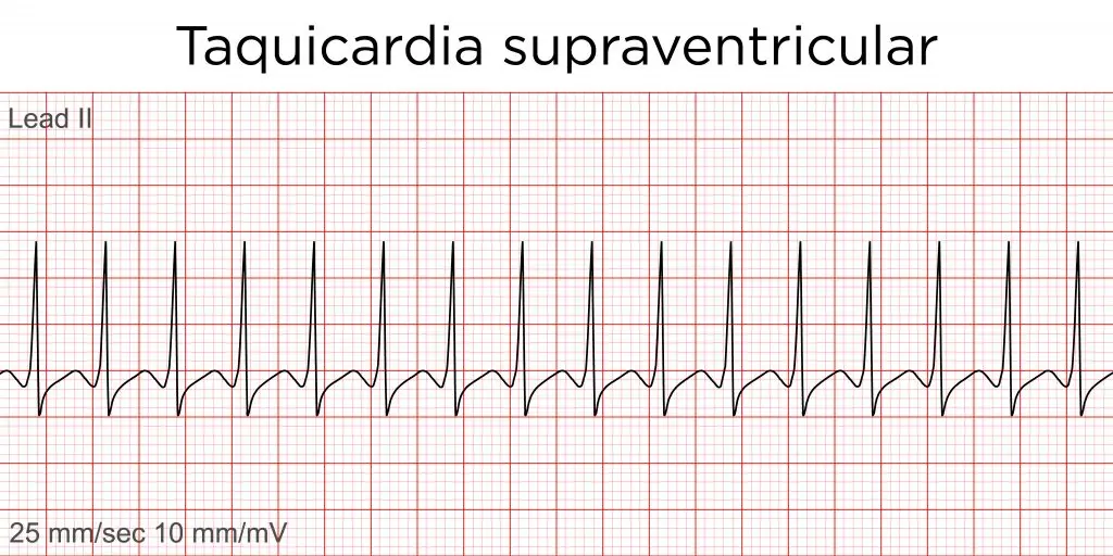 Taquicardia Supraventricular: Causas, Síntomas, Diagnóstico y Tratamiento - Qué puede provocar una taquicardia supraventricular taquicardia paroxistica supraventricular ecg - Qué puede provocar una taquicardia supraventricular