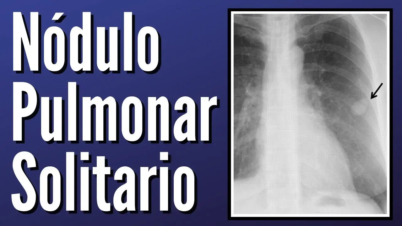 Nódulo Pulmonar Solitario: Diagnóstico y Manejo - Qué quiere decir nódulo pulmonar solitario nodulo pulmonar solitario - Qué quiere decir nódulo pulmonar solitario