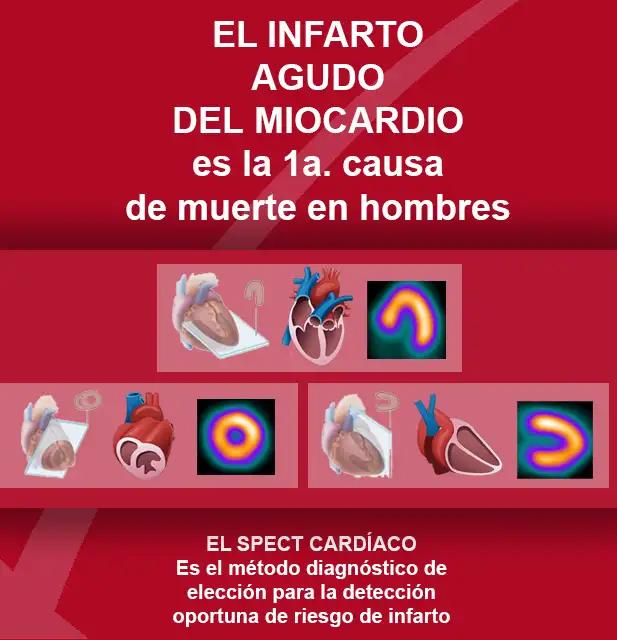 Perfusión miocárdica: Un examen para evaluar la salud del corazón - Qué radiactivo se usa para realizar el test de perfusión miocárdica perfusión miocárdica riesgos - Qué radiactivo se usa para realizar el test de perfusión miocárdica