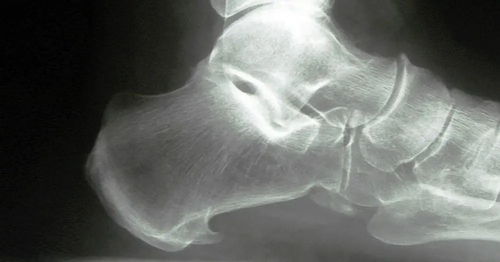 Fascitis Plantar: Diagnóstico y Tratamiento con Ecografía - Qué radiografía se pide para fascitis plantar fascitis plantar ecografia - Qué radiografía se pide para fascitis plantar