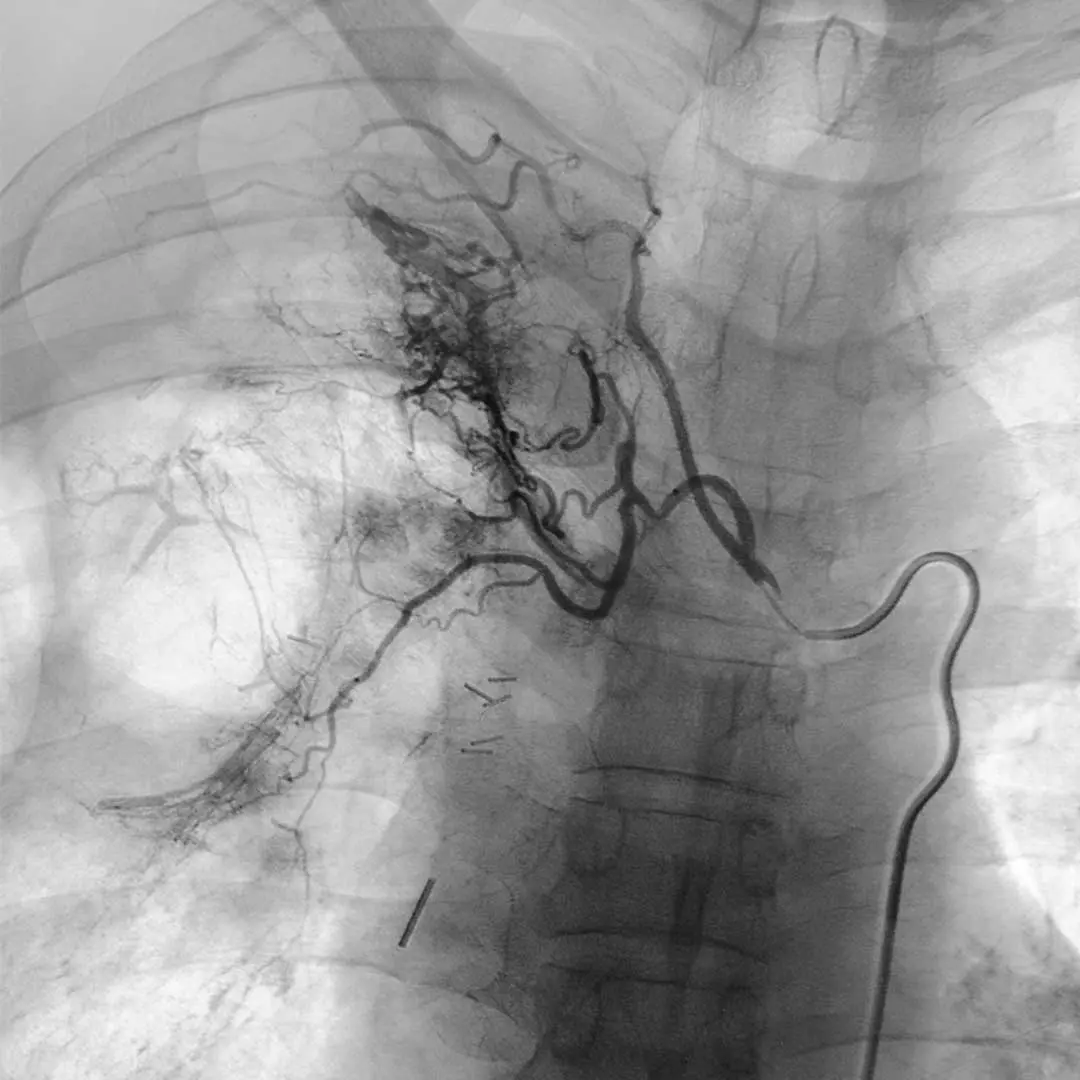 Angiografía: Qué es, cómo se realiza y riesgos asociados - Qué riesgos tiene la angiografía angiografia - Qué riesgos tiene la angiografía