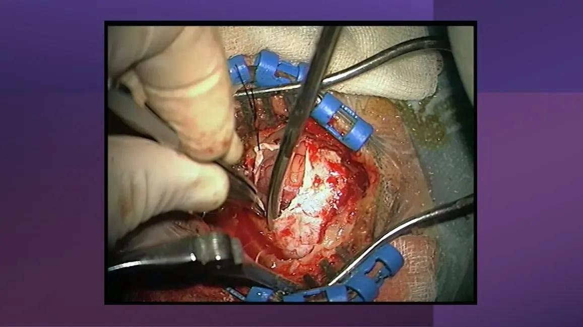 Neuralgia del Trigémino: Causas, Síntomas y Tratamiento - Qué riesgos tiene la cirugía del trigémino cirugia del trigemino - Qué riesgos tiene la cirugía del trigémino