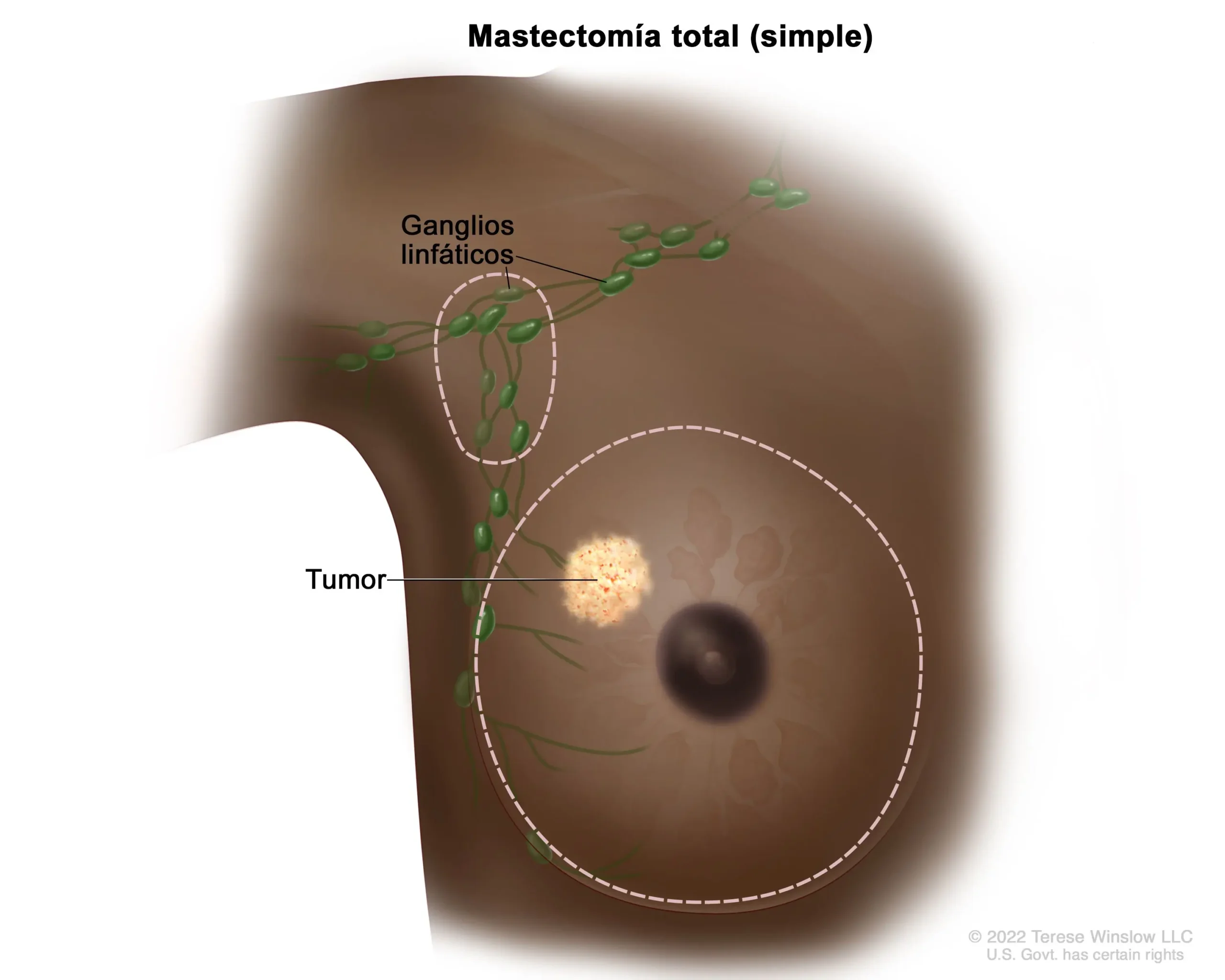 Mastectomía Simple: Todo lo que Necesitas Saber - Qué se considera una mastectomía simple mastectomia simple - Qué se considera una mastectomía simple