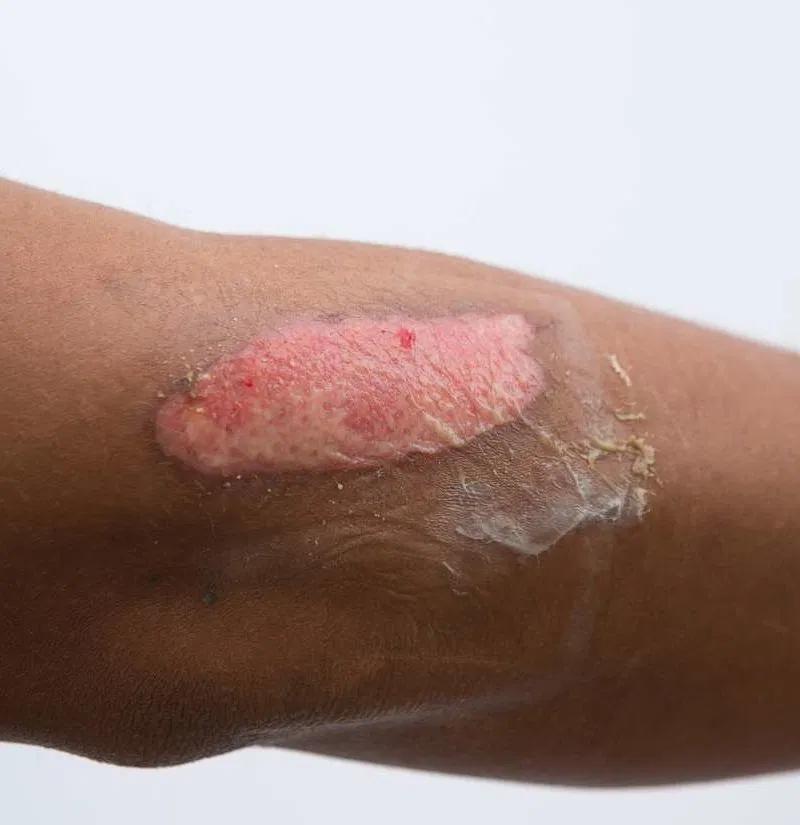 Cómo curar una quemadura infectada: Guía completa para una recuperación exitosa - Qué se debe hacer cuando una quemadura se infecta como curar una quemadura infectada - Qué se debe hacer cuando una quemadura se infecta