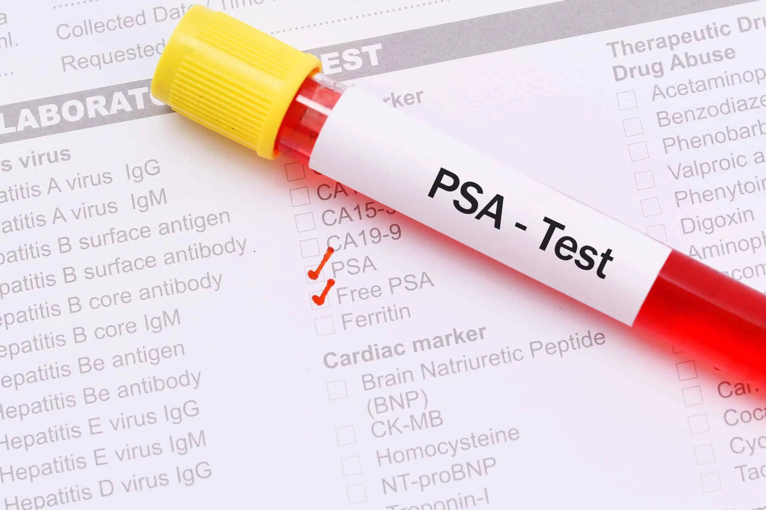 PSA Alto: Qué es, Causas, Diagnóstico y Tratamiento - Qué se debe hacer para bajar el PSA psa alto - Qué se debe hacer para bajar el PSA