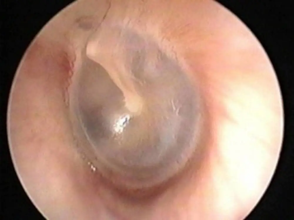 Otoscopia: Una Mirada al Interior del Oído - Qué se puede encontrar en una otoscopia otoscopia - Qué se puede encontrar en una otoscopia