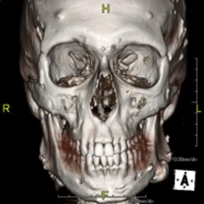 tomografia macizo craneofacial - Qué se puede ver en una tomografía de cráneo