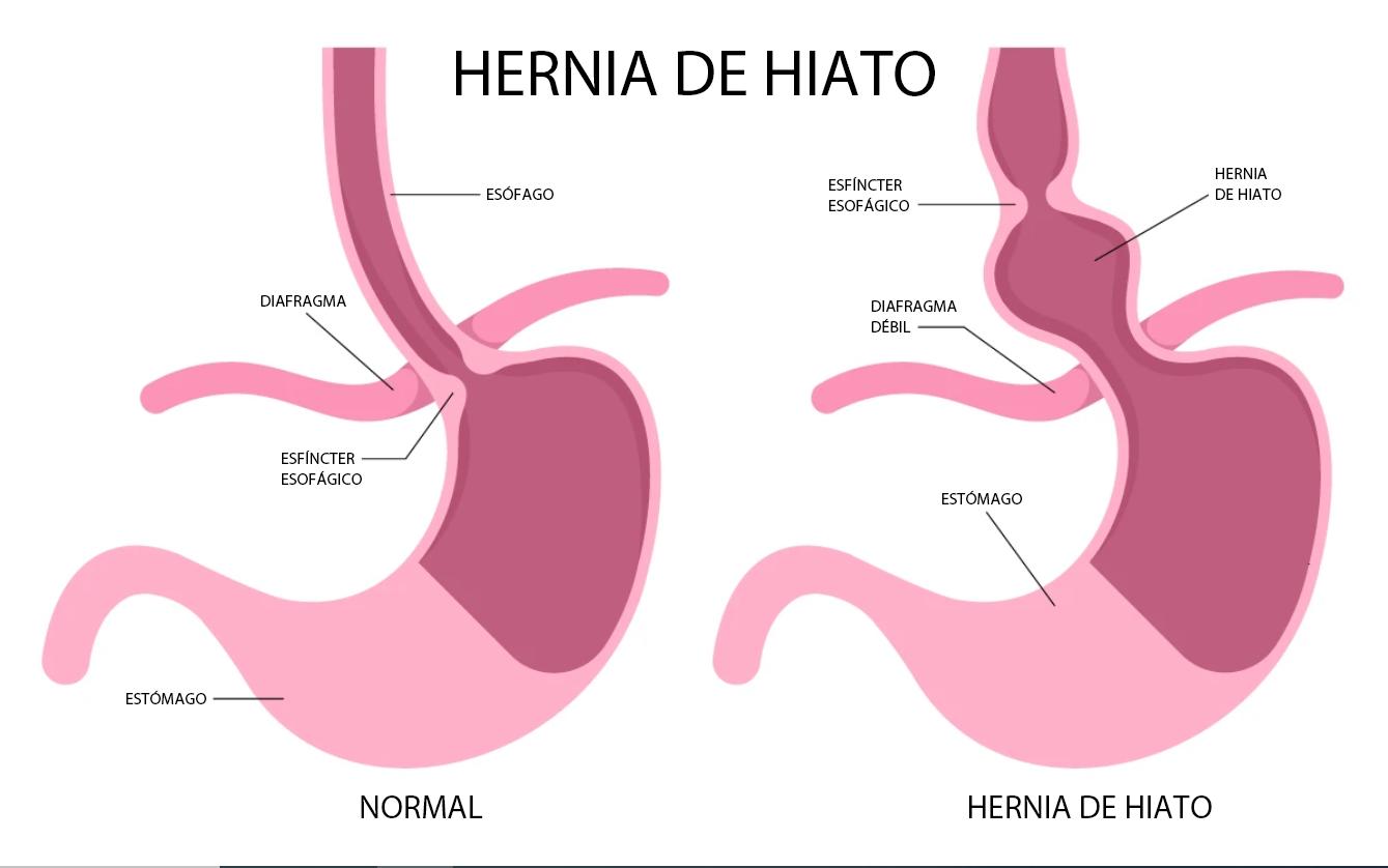Hernia Hiatal: Síntomas, Causas Y Diagnóstico | Doctor Online