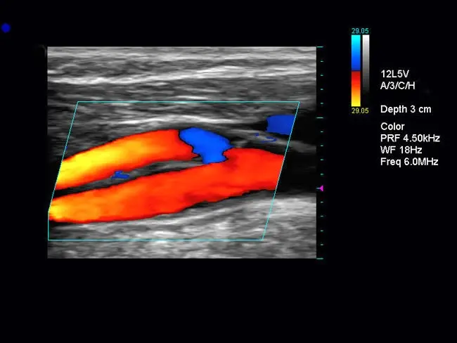 Eco Doppler Carotídeo: Explorando la Salud de Tus Arterias - Qué se ve en un eco doppler de cuello eco doppler carotideo - Qué se ve en un eco doppler de cuello