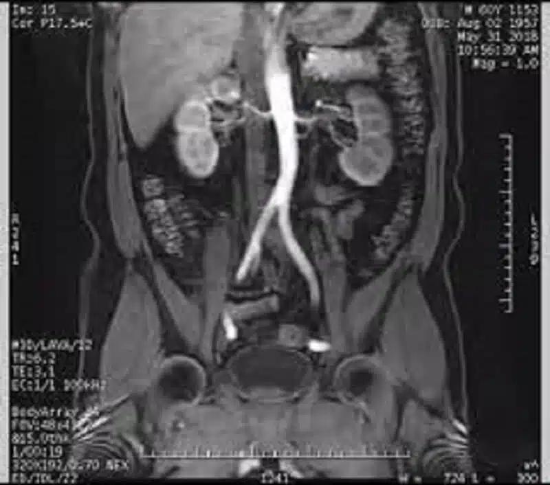 Resonancia de Abdomen: Una Guía Completa para Entender la Prueba - Qué se ve en una resonancia de intestino resonancia de abdomen - Qué se ve en una resonancia de intestino